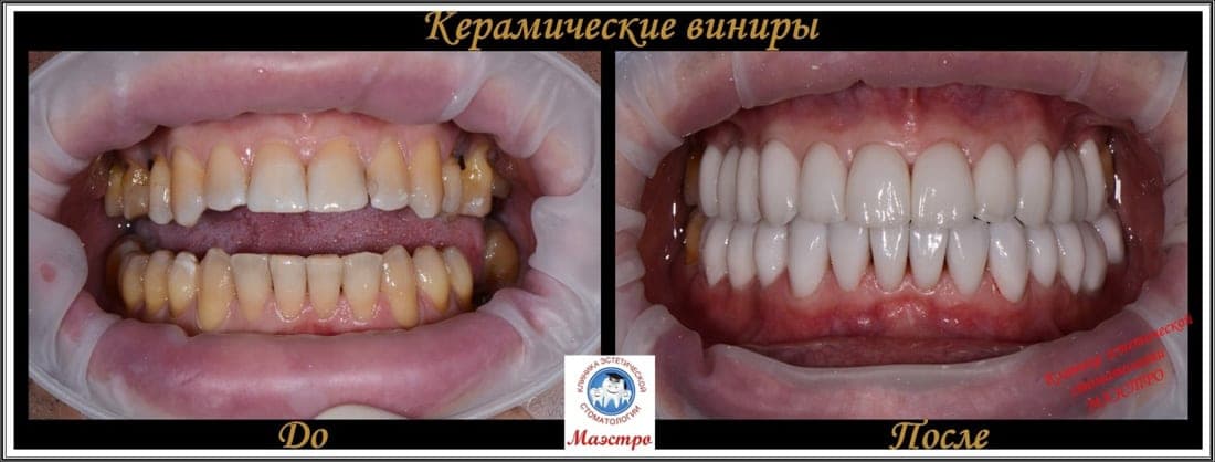Клинический случай: керамические виниры — до и после