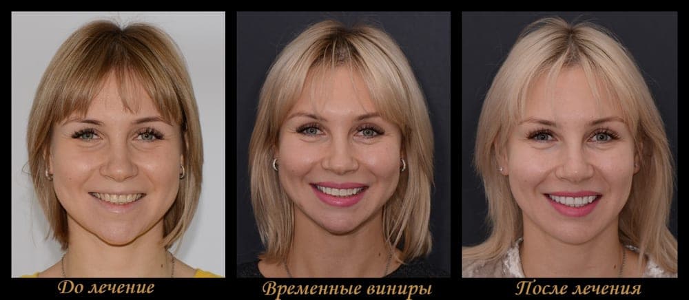 Клинический случай установки виниров Emax — до и после