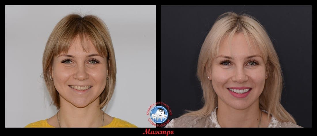 Клинический случай восстановления формы и цвета зубов — до и после