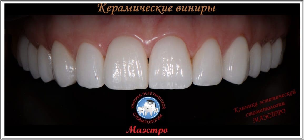 Клинический случай полного преображения улыбки — до и после