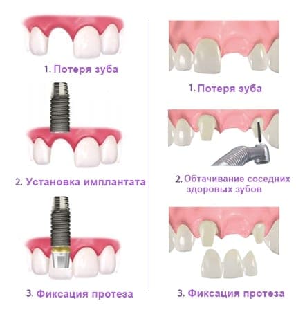 Компоненты дентального имплантата