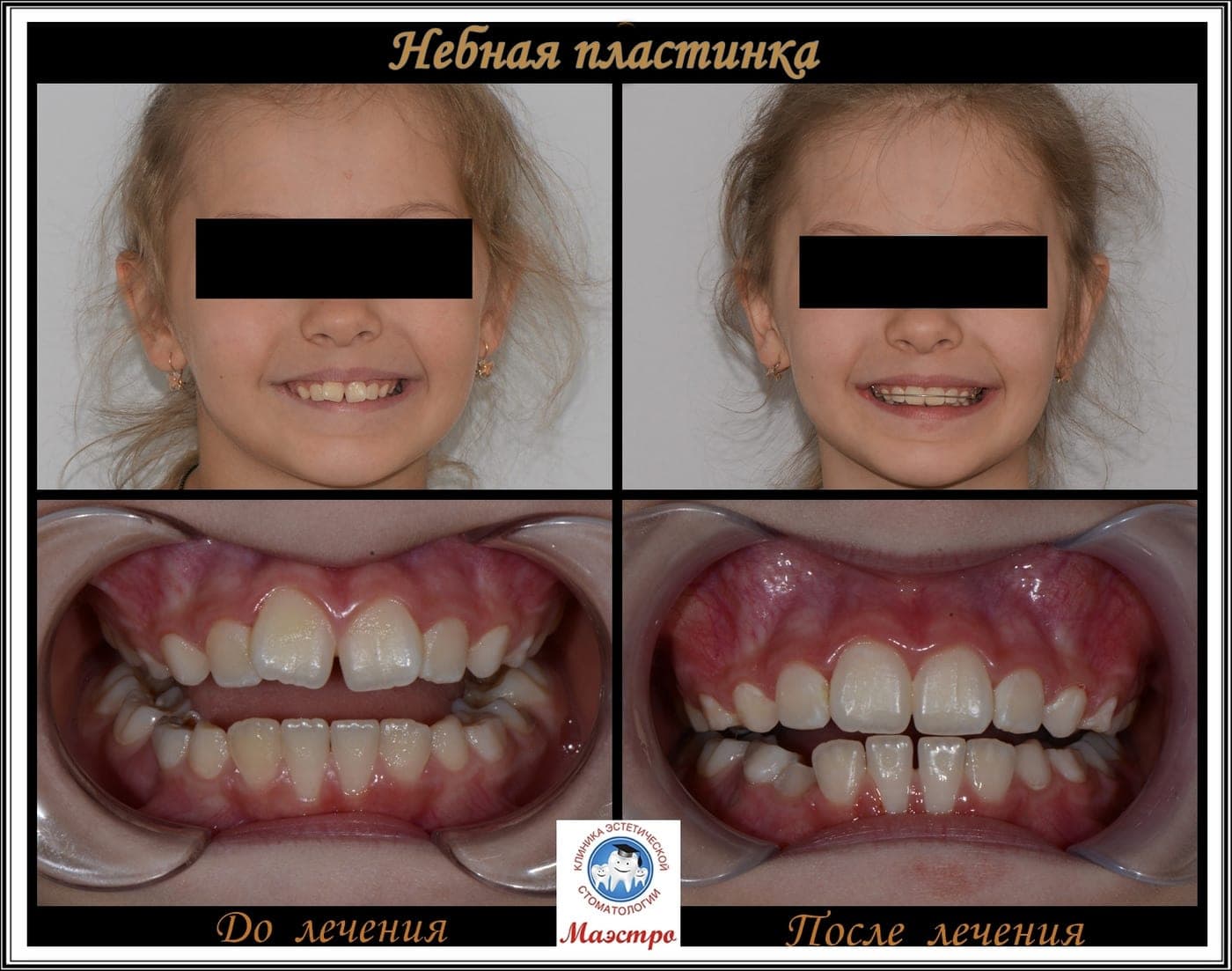 Результат ортодонтического лечения