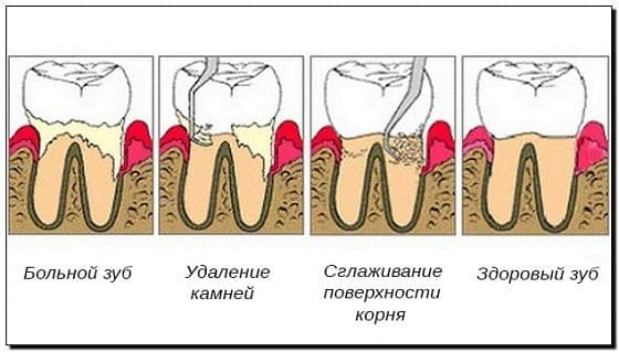 Лоскутная операция при заболеваниях пародонта