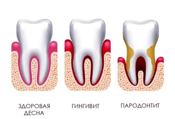 Схема пародонтального кармана
