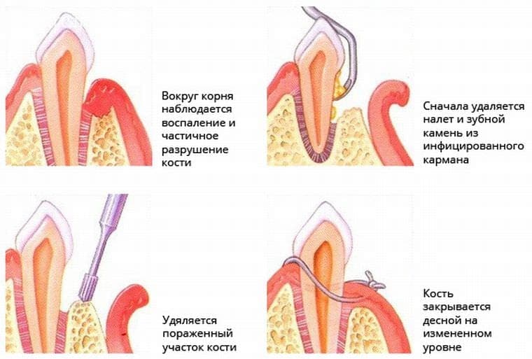 Открытый кюретаж при лечении пародонтита