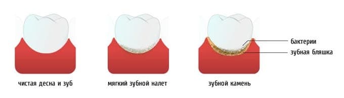 Зубной налёт на поверхности зубов