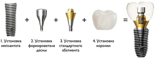 Коронка на имплантате
