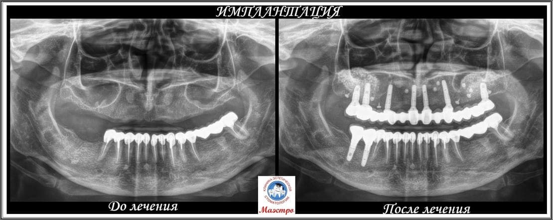 Имплантация с двусторонним синус-лифтингом — до и после