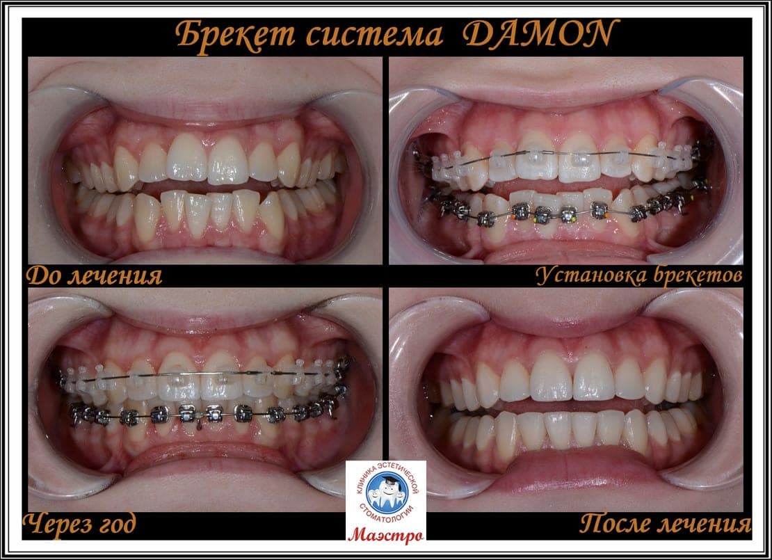 Ортодонтия — пациент 1, фото 1