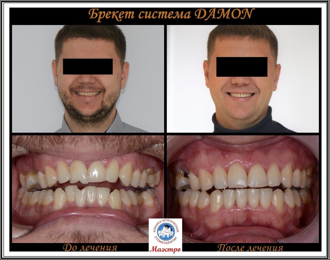 Ортодонтия — пациент 3, фото 1