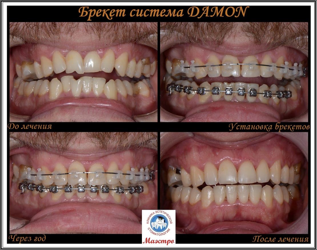 Ортодонтия — пациент 3, фото 3