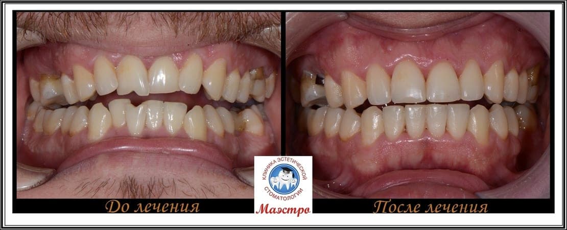 Ортодонтия — пациент 3, фото 4