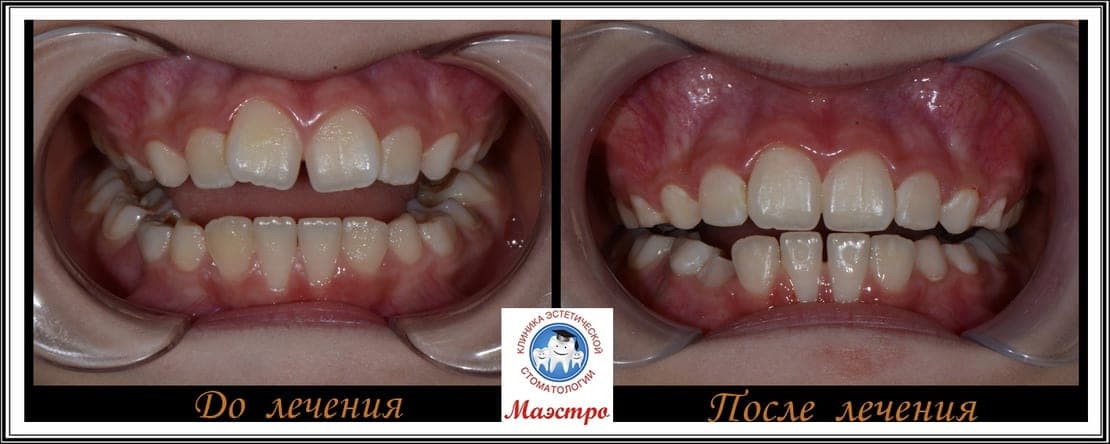 Ортодонтия — пациент 5, фото 2