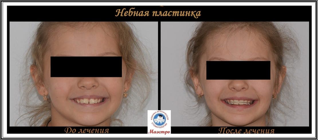 Ортодонтия — пациент 5, фото 3