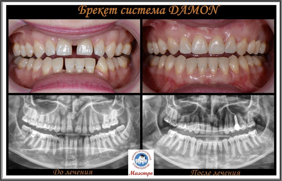 Ортодонтия — пациент 6, фото 1