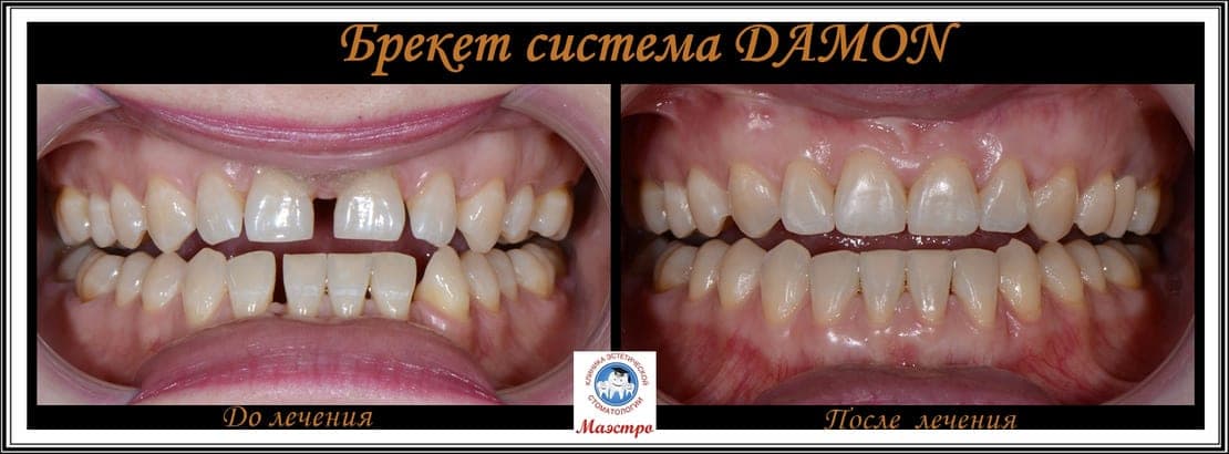 Ортодонтия — пациент 6, фото 2
