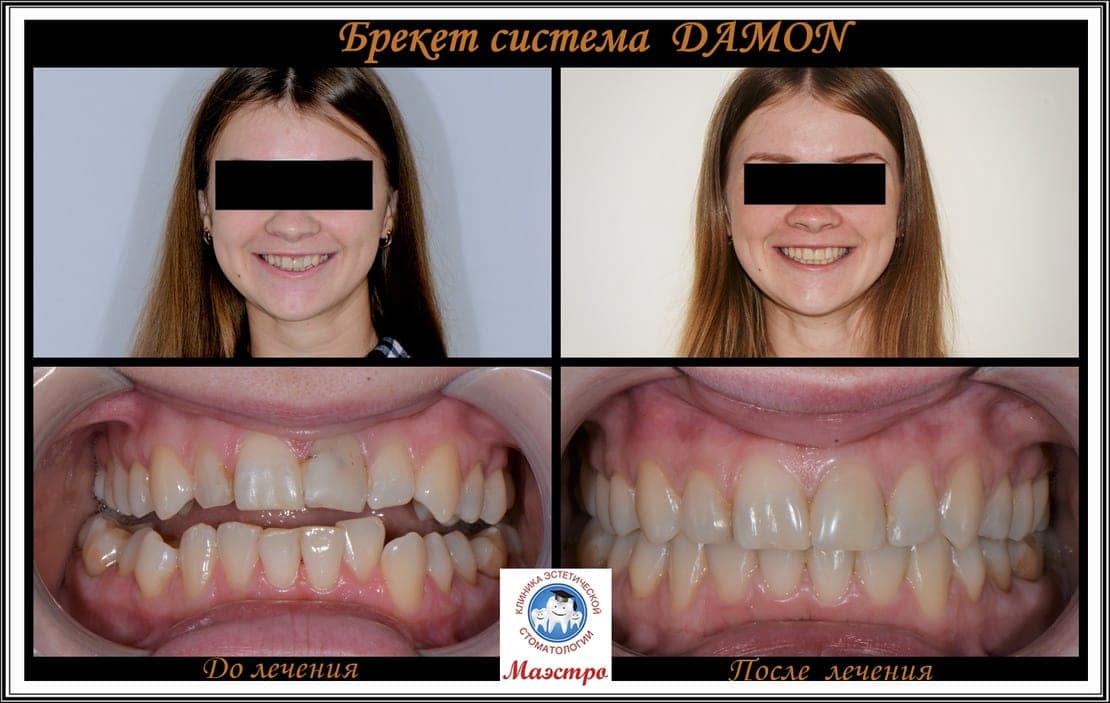 Ортодонтия — пациент 7, фото 1