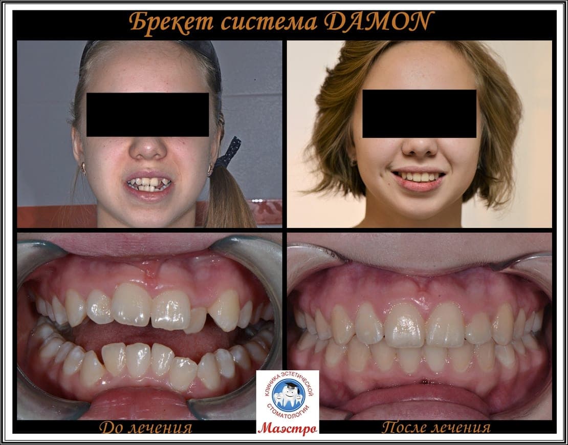 Ортодонтия — пациент 8, фото 1