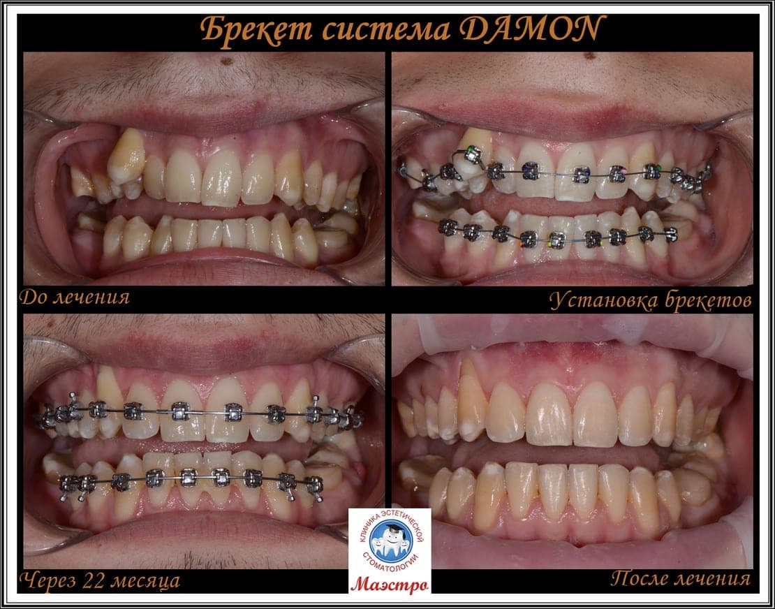Ортодонтия — пациент 9, фото 3