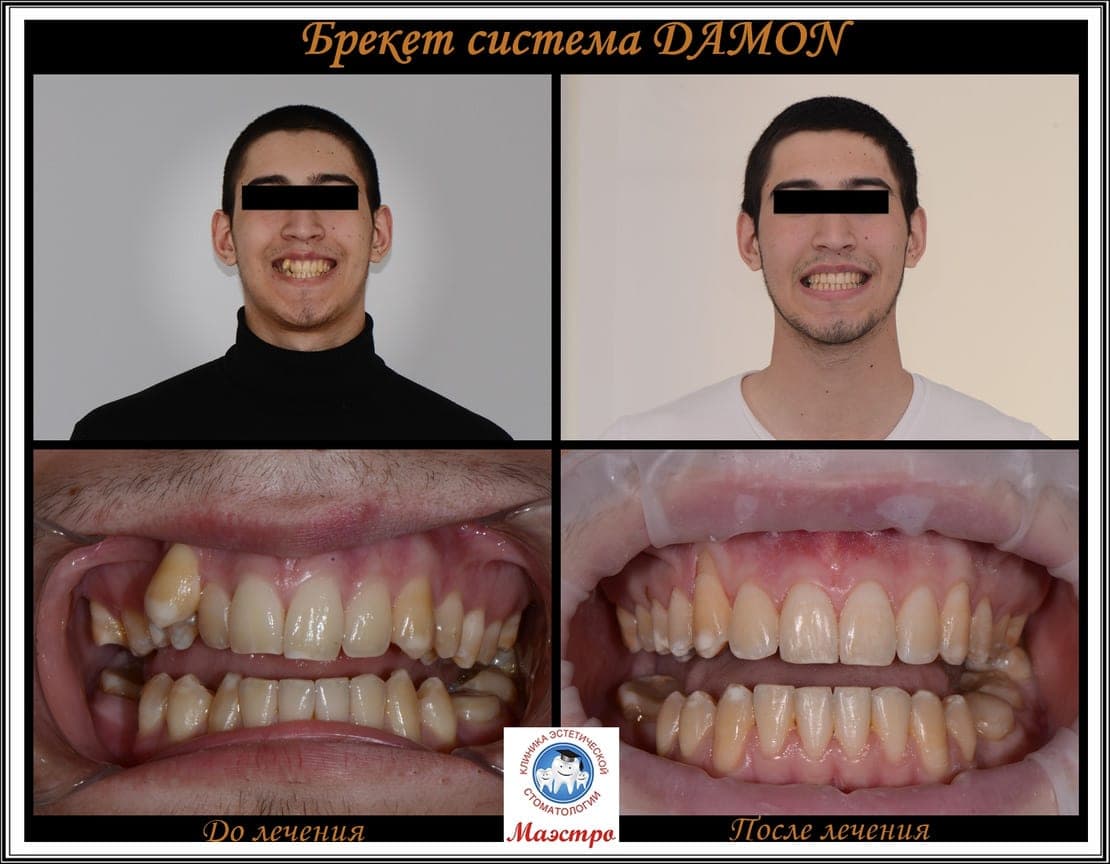 Ортодонтия — пациент 9, фото 4