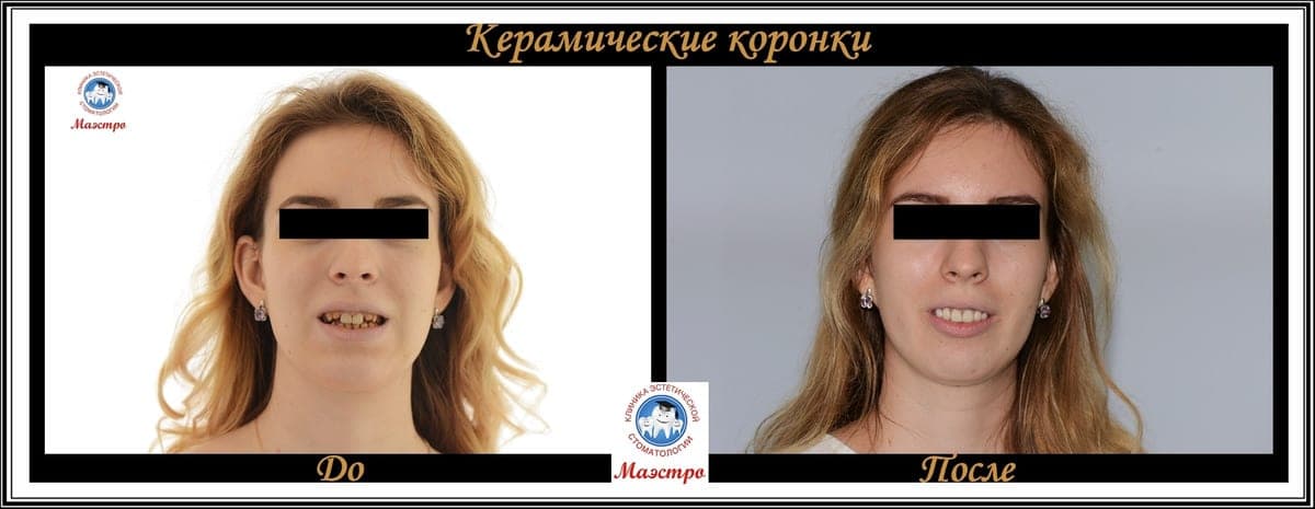 Ортопедия — пациент 1, Улыбка до лечения