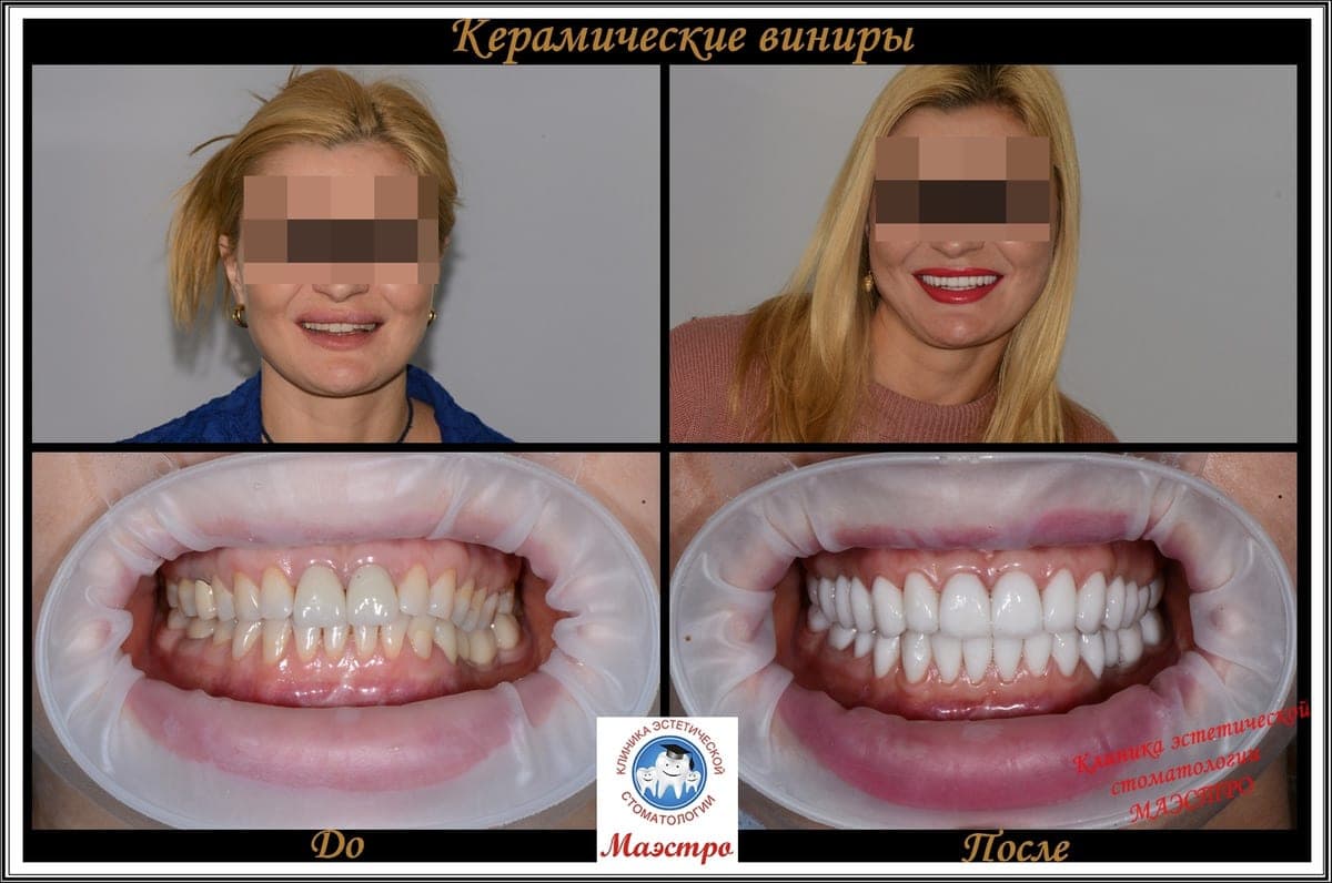 Ортопедия — пациент 10, Улыбка до лечения