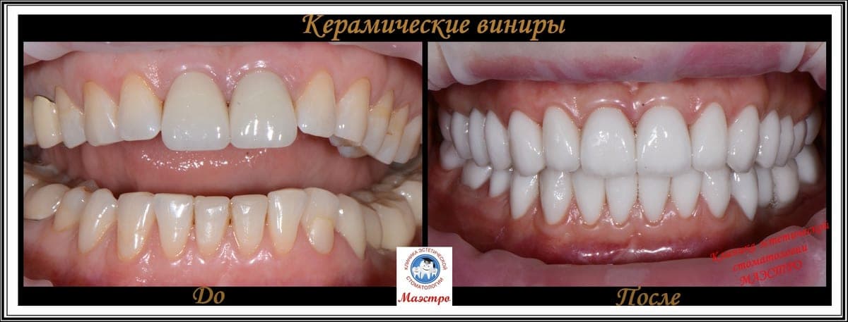 Ортопедия — пациент 10, Улыбка после виниров
