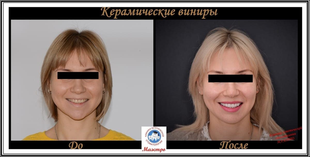 Ортопедия — пациент 14, Анфас до лечения