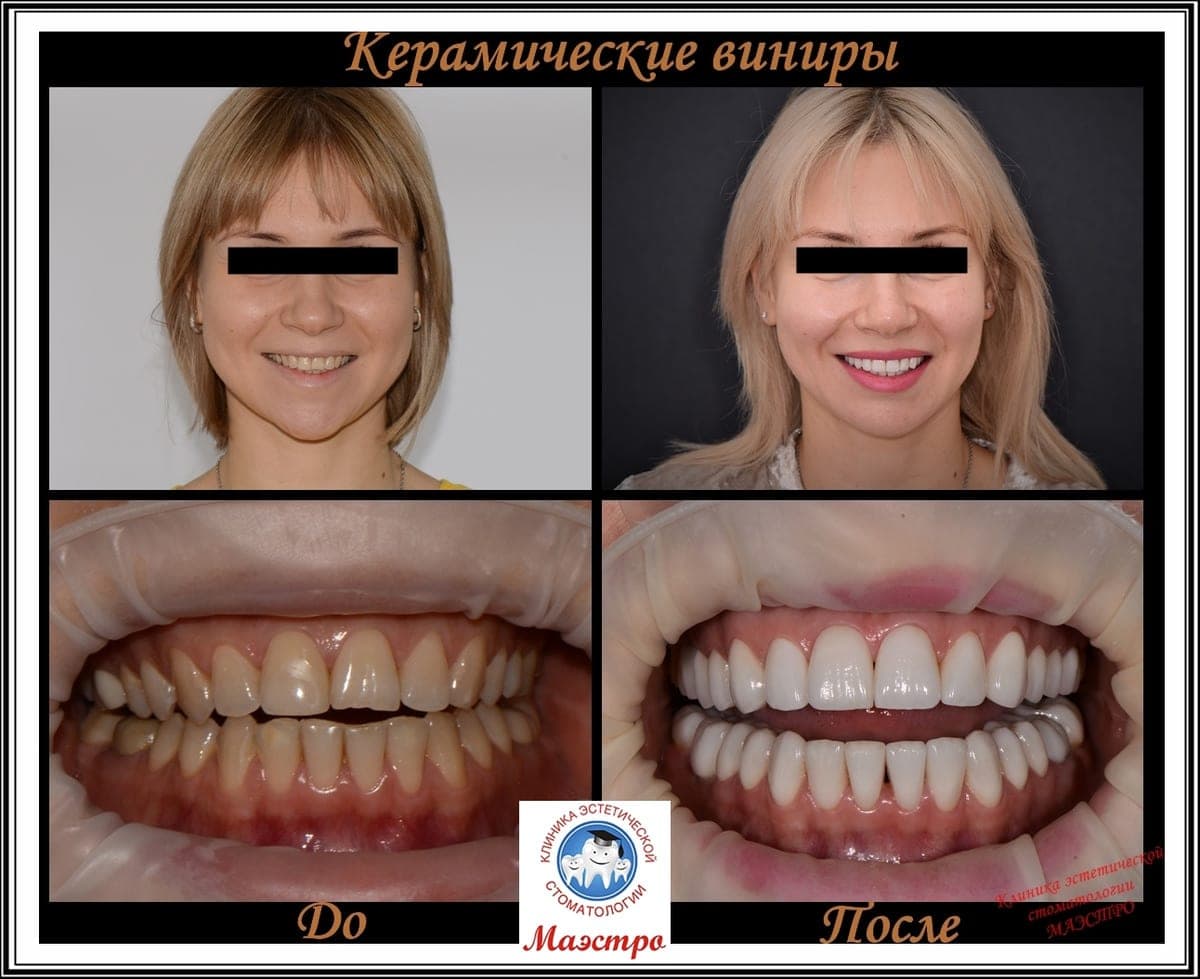 Ортопедия — пациент 14, Анфас после лечения