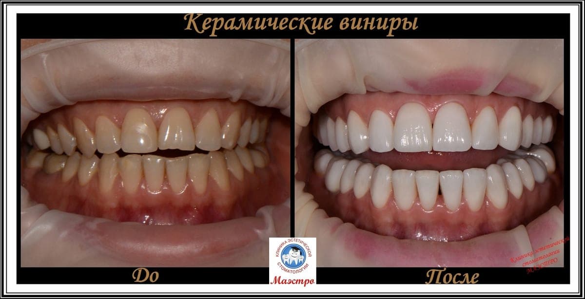Ортопедия — пациент 14, Профиль до и после