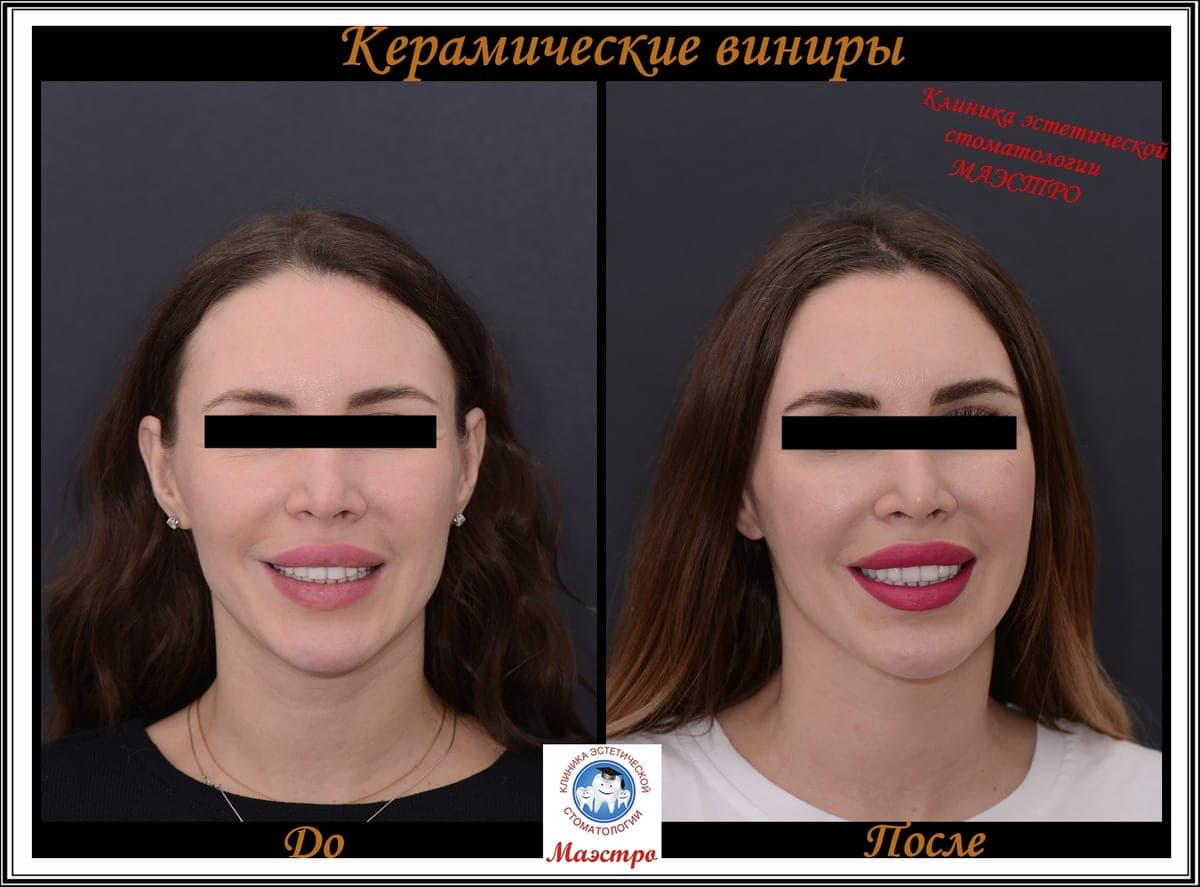 Ортопедия — пациент 15, Улыбка до лечения