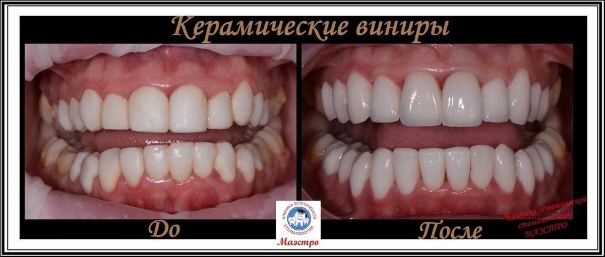 Ортопедия — пациент 15, Улыбка после лечения
