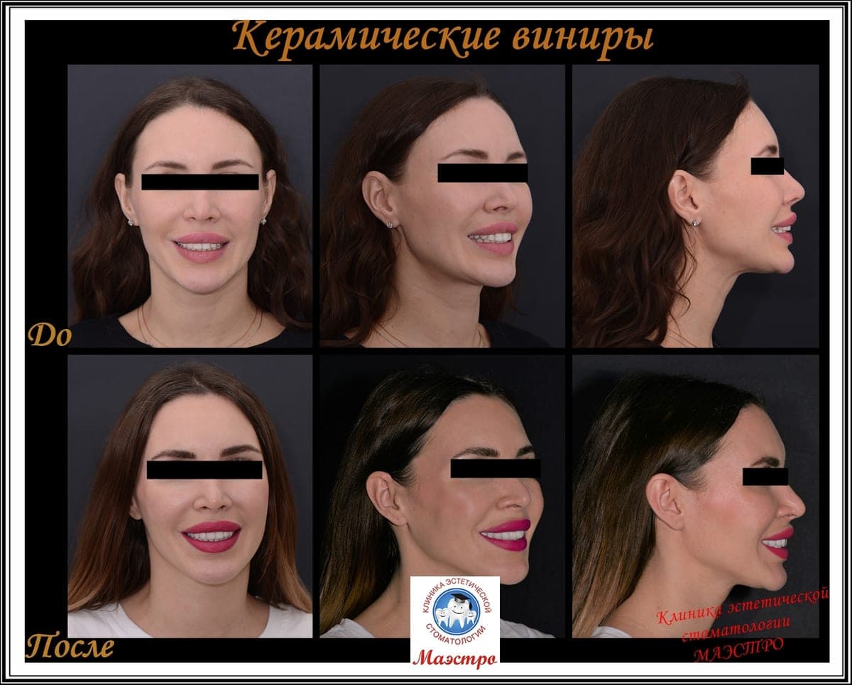 Ортопедия — пациент 15, Зубной ряд до