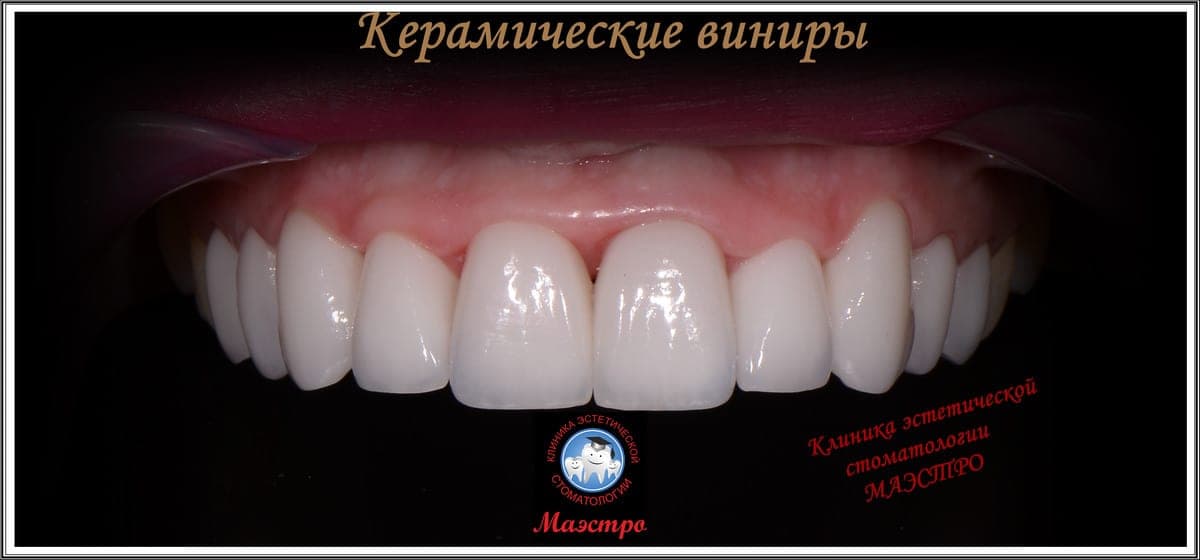 Ортопедия — пациент 15, Зубной ряд после