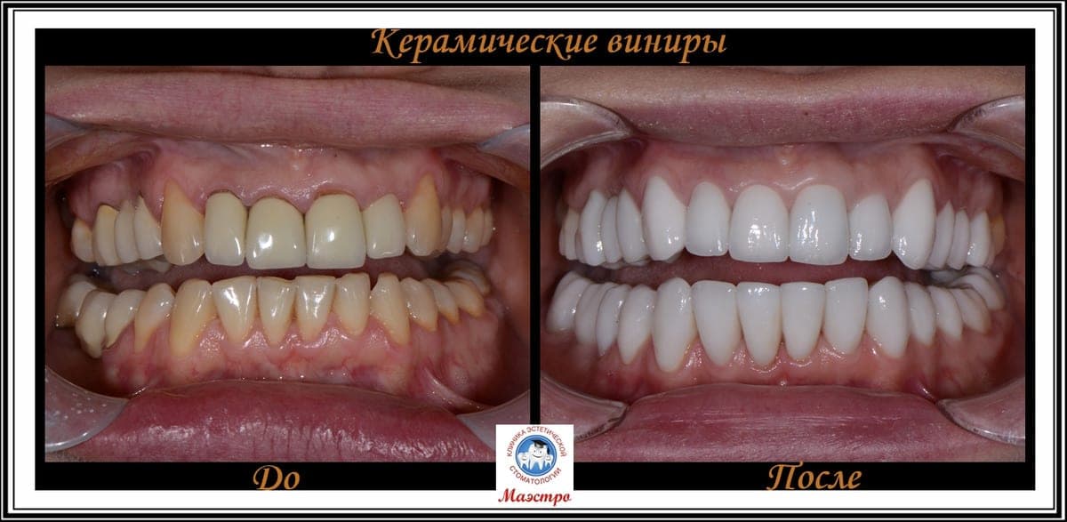 Ортопедия — пациент 18, Зубные ряды до лечения
