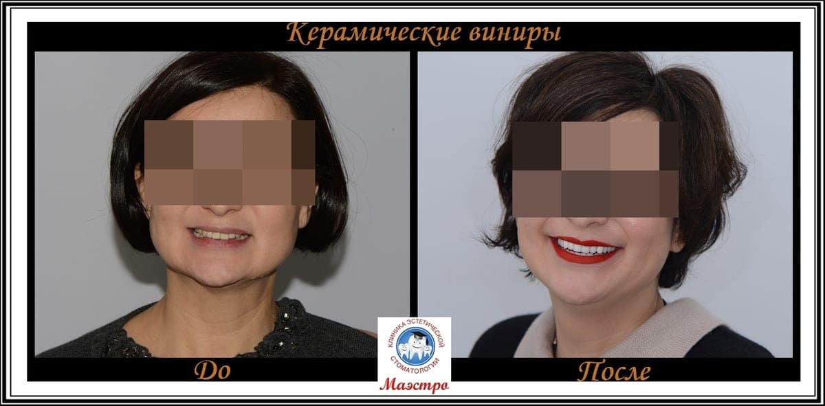 Ортопедия — пациент 18, Результат на обеих челюстях