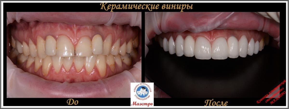 Ортопедия — пациент 2, Зубной ряд до лечения