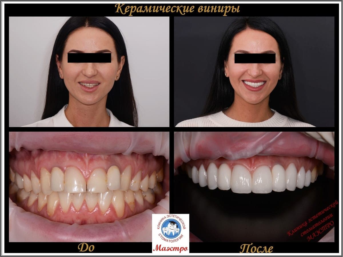Ортопедия — пациент 2, Зубной ряд после виниров