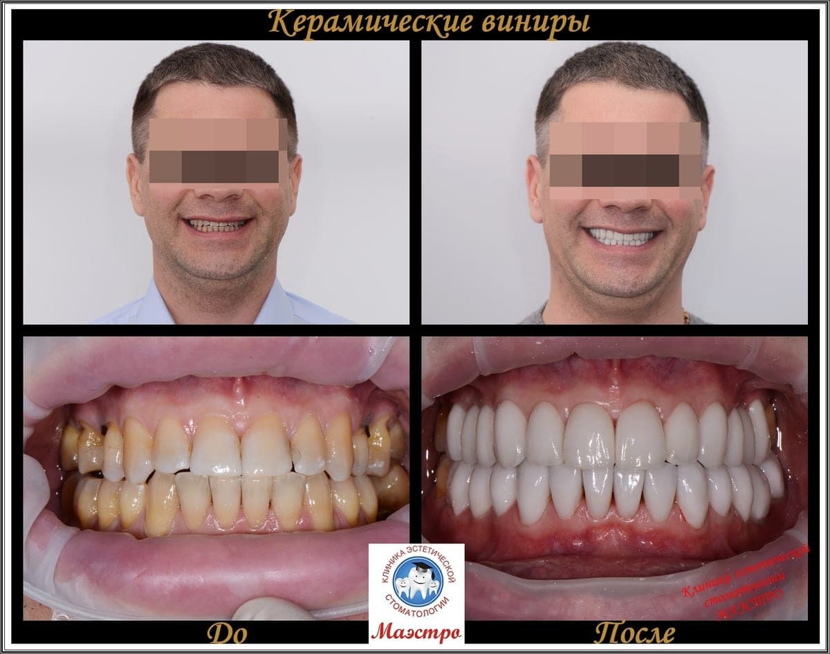 Ортопедия — пациент 4, Улыбка после виниров