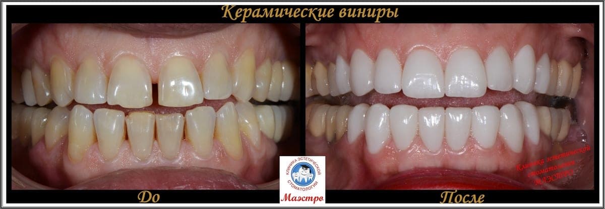 Ортопедия — пациент 5, Щель до лечения