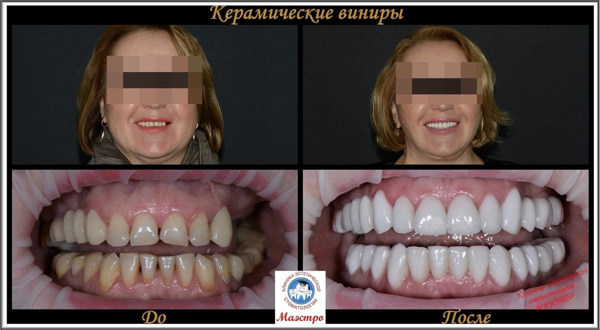 Ортопедия — пациент 6, Зубной ряд до лечения