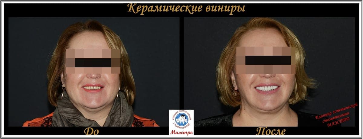 Ортопедия — пациент 6, Результат после виниров