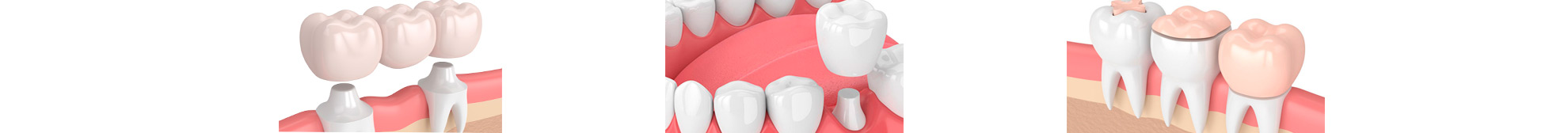 Протезирование - Клиника эстетической стоматологии 